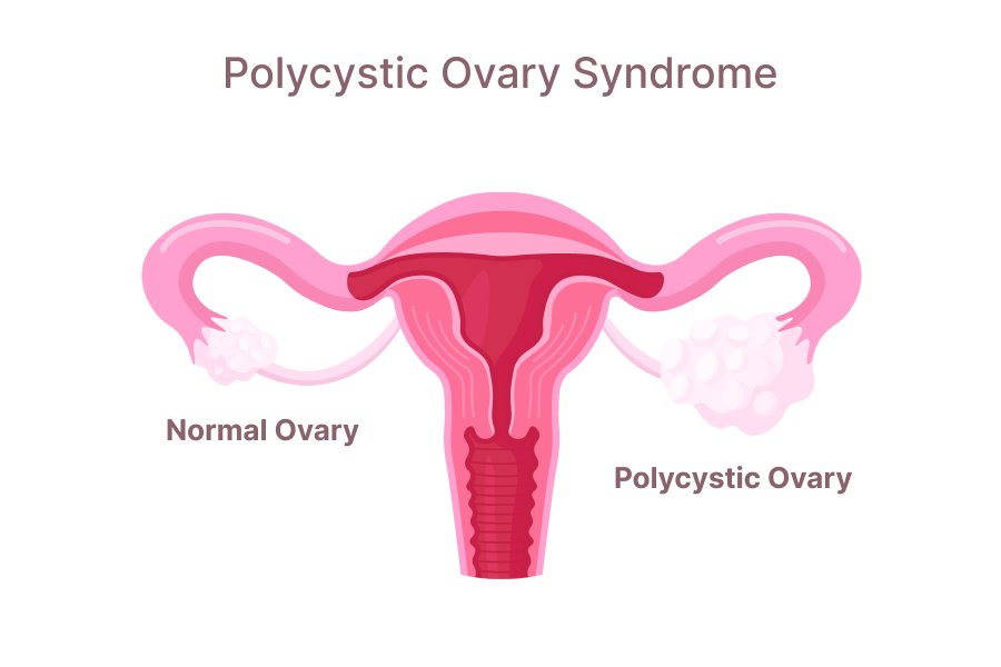 Infographic of Polycystic Ovary Syndrome - showing Ovaries and female reproductive system