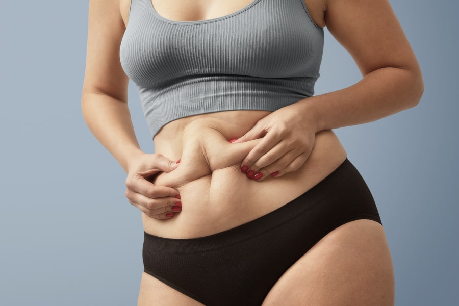 Woman pinching her belly depicting What does a PCOS Belly Look Like