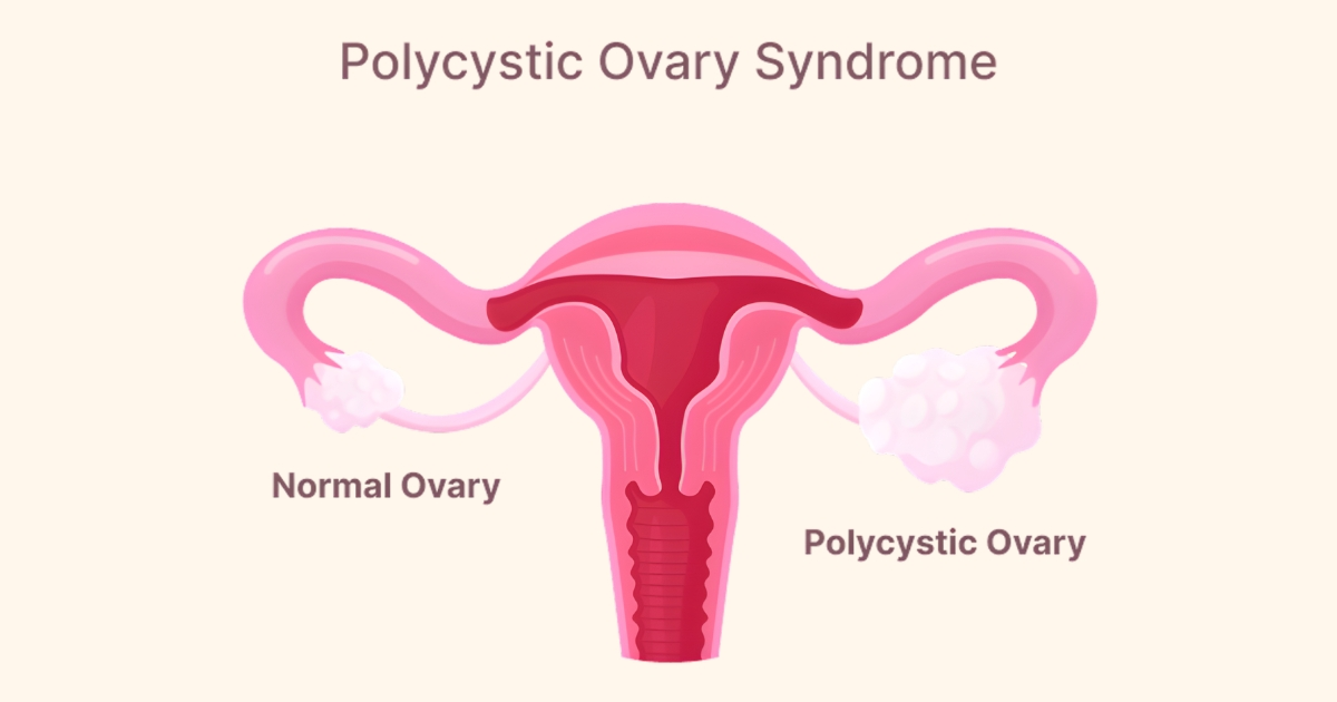 PCOS Belly